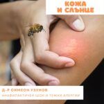 Алергия след ужилване от инсекти